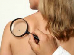 Шахтинцы смогут получить бесплатную консультацию вопросам диагностики меланомы