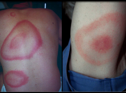 В Шахтах обнаружены опасные клещи