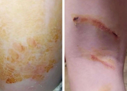 12-летний ребенок стал жертвой нападения собак, возвращаясь из школы в Шахтах