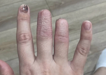 Шахтинка лишилась двух фаланг пальцев, упав вместе со столом в кафе