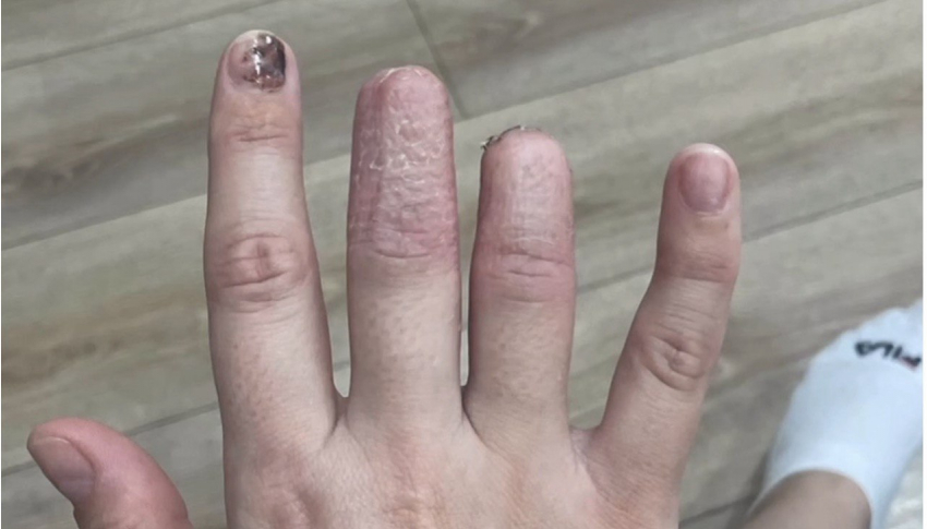 Шахтинка лишилась двух фаланг пальцев, упав вместе со столом в кафе